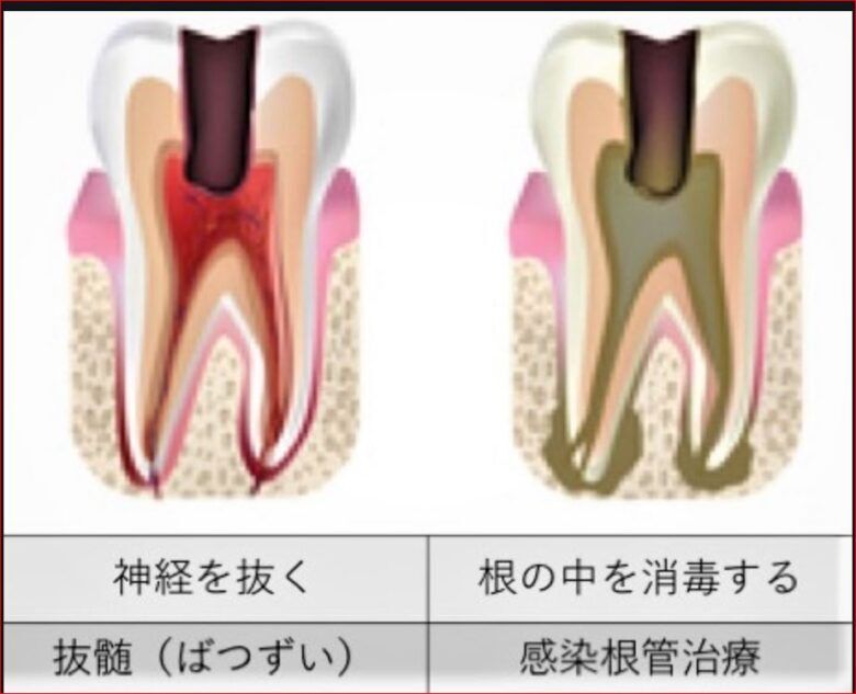 歯の痛み