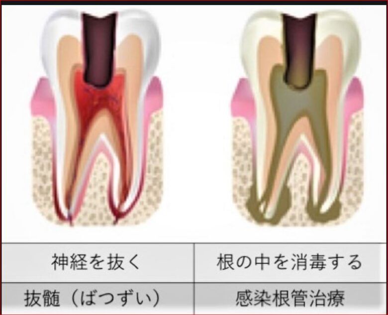 神経の治療