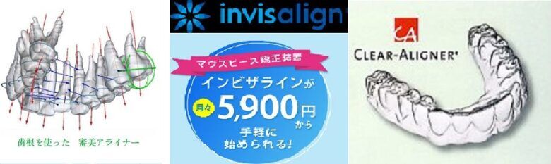 invisalign