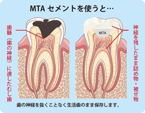 痛くない虫歯治療