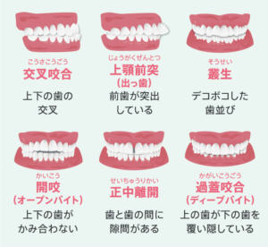 歯並び