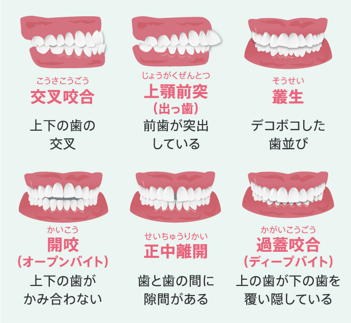 歯並びの異常