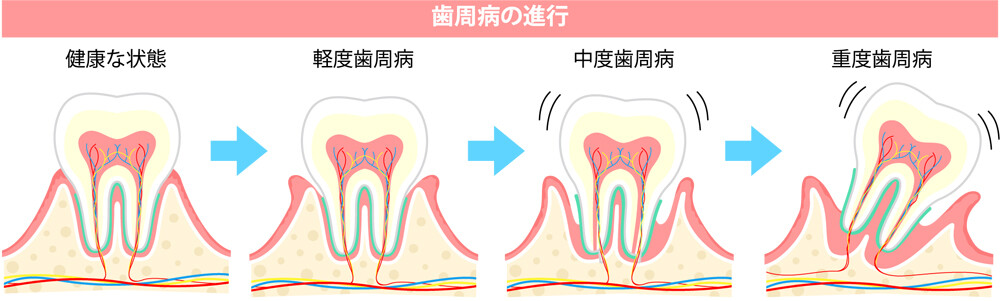 歯周病の進行