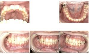 インビザライン治療１年後