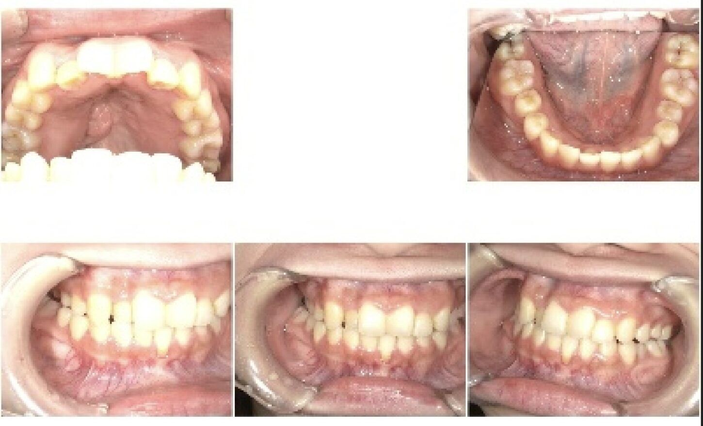 invisalignafter
