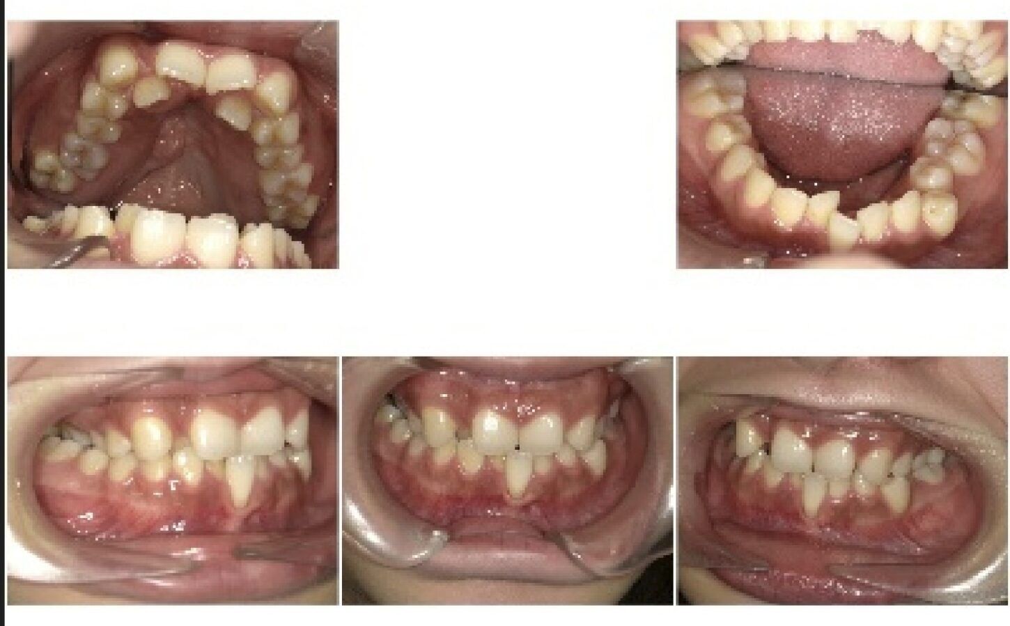 invisalignbefor