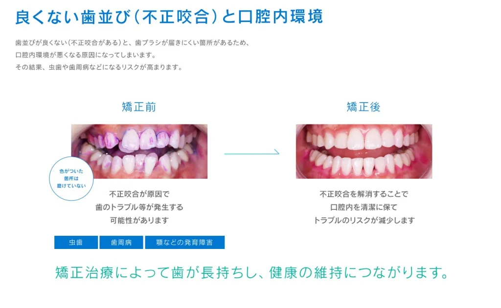 良くない不正咬合