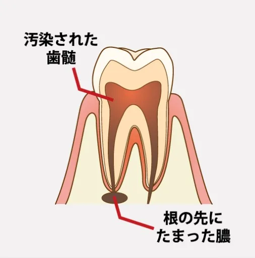 根の先の膿