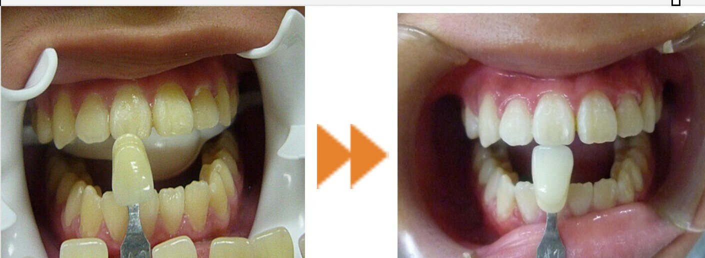 whitening-1